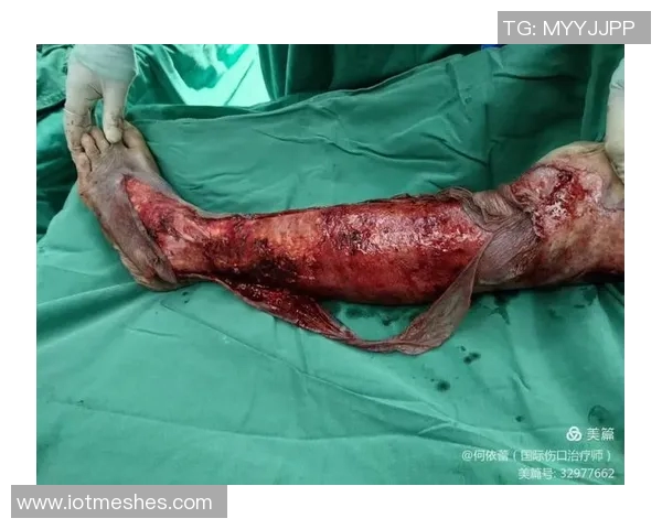 莱万遭遇重伤左大腿肌肉撕裂预计缺阵四到六周