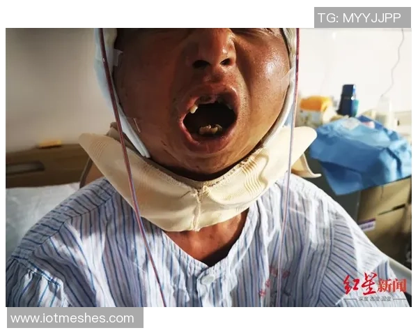 穆阿尼遭马奎尔撞击下巴受伤无需手术预计缺阵六到八周